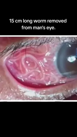 #eyes #optics #Optometrist #optician #worm #eyeworms #fypage #fyp #foryou 