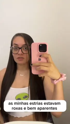 Evolução da Soraia tratando estrias da gravidez com o Cicatrissim creme para estrias. . #estrias #gravidez #posparto #autoestima #amamentação 