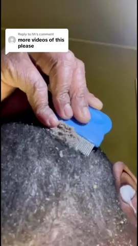Replying to @hh Storyless Scratch with Psoriasis Barbie come vibe!! The full video to this is on her YouTube “Psoriasis Barbie”!! #dandruff #dandruffremoval #dandruffproblem #soothing #anxiety #foryou #satisfying #fyp #viral #dandruffscratching 