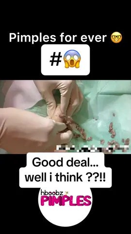 #pimples #cyst #pimple #horror #medical #blackhead #bigpimple #pimpleremoval #disgusting #pimplepop #cystexplosion #squeeze #skincare #acne #abscess #squeezeyuk #satisfying 