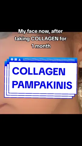 after 1 month nawala agad mga pimples ko, thank you collagen! #collagen #collagenforacne #pampakinisngmukha😘 #pampakinis #pampabatakngface #fyp #foryou #acnetreatment #affordableacnetreatment 
