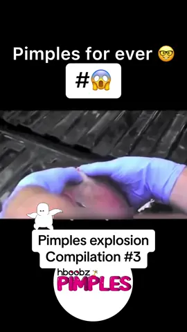 #pimples #cyst #pimple #horror #medical #blackhead #bigpimple #pimpleremoval #disgusting #pimplepop #cystexplosion #squeeze #skincare #acne #abscess #squeezeyuk #satisfying 