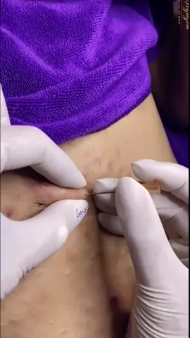 #pimple #blackhead #pimplepoppersatisfying 