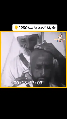 طريقة الحجامة التقليدية قديما #hijama #الحجامة_العلاجية #الحجامة #الحجام #المغرب🇲🇦تونس🇹🇳الجزائر🇩🇿 #الاردن #السعودية #البحرين #الكويت #العراق #اكسبلورexplore #العلاج_الطبيعي #cupping #القولون_العصبي  #fypシ 