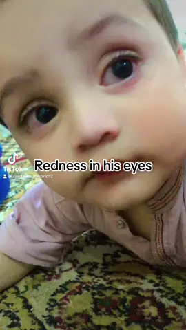 My Allergic baby 😕#allergicbaby #eyeredness #babysick☹️ #politedoctor