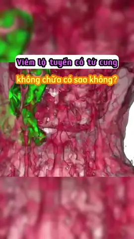 Viêm lộ tuyến ctc không chữa có sao không? #sinhly #chiemchungminh #suckhoe #phukhoa #hanoi #viral #xuhuongtiktok