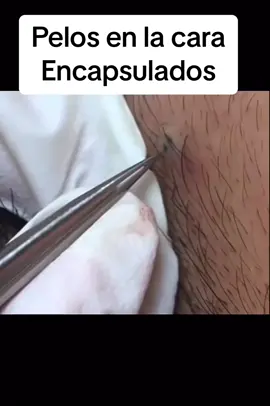 #extractions #puntosnegros #acne #grasa #espinillas #granos #