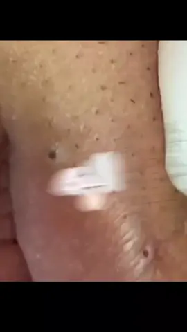 #squeeze #squeezeyuk #pimple #pimplepop #acne #skincare #blackhead #fouryou 