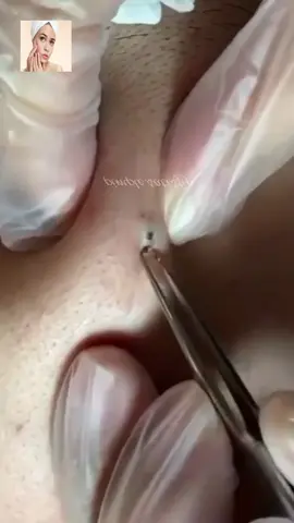 #squeeze #squeezeyuk #acne #pimple #pimplepop #blackhead #satisfying #foryoupage 73