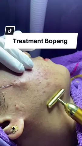Paket bundling best seller untuk mengurangi bopeng 🥰 #klinikkecantikan #rcs #subsisi #bopengtreatment #serumdnasalmon #fypdongggggggg #lomboktiktok 
