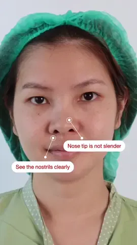 #Unlock your beauty with Pmed Clinic: Premier Bangkok Plastic Surgery Add LINE : @pmed ( have @ in front) Click 👉🏻 : https://bit.ly/2QW3OmQ ______________________________ 📋 Consult or make an appointment with Dr,Ton Free! No charge! Address : Pmed Clinic, 2nd floor, SJ Infinite l building ,Vibhavadi Rangsit ,Phahonyotin  Open daily (Except Monday) at 9am.-5pm. 📲 Call Center : 096-645-1465 📷 Instagram: @pmedclinic ✅Line ID : @Pmed  Messenger inbox : m.me/110732118515917 🌏Website : https://www.pmedclinic.com/english 🟦Facebook : English Version ⭐️ https://www.facebook.com/pmedclinic.sg 🟦Facebook : Thai version for live streaming immediately after the operation ⭐️ https://www.facebook.com/Pmedclinic  #nosesurgery #rhinoplasty #thaiplasticsurgery #pmedclinic #openreconstruction #pmedfatgraft #facialfatgrafting #fatgrafting #fattransfer #plasticsurgery#pmedclinicthailand #thailandplasticsurgery