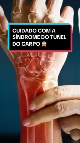 Voce sabe o que é Síndrome do Túnel do Carpo ?? #tuneldocarpo #sindromedotuneldocarpo #formigamentonasmãos #dormencianasmaos #dicadesaude #nervomediano #formigamentos 