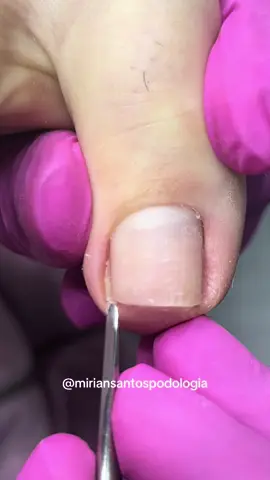 De qual cidade vocês são?? #unhas #unhasencravadas #podologiacomamor #podologia #foryou #fyy #viral #unhasinfecciondas #videosatisfatorio #onicofosedemilhao 