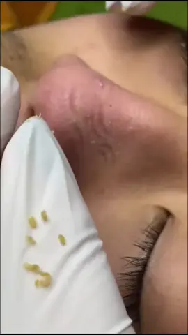 #pimplepoppersatisfying 