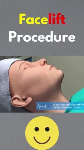 Facelift Procedure #face #facelifting #procedure #treatment #3danimations #surgery #watch #foryou