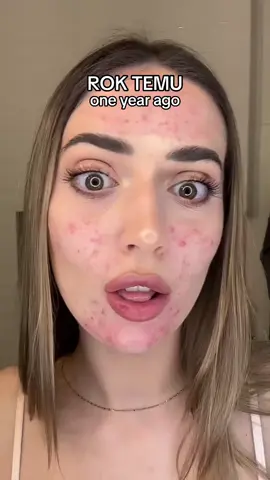 #stitch z użytkownikiem @aleksa🧸🤍 ja kiedy ktoś mi mówi, że pielęgnacja i styl życia nie mają znaczenia przy trądziku 🥹🤍 #acne #acnepositivity #acnetreatment #trądzik #leczenietrądziku 