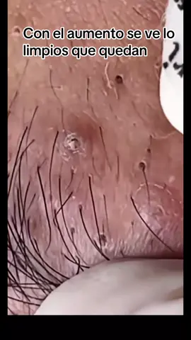 #Extracción#poros#granos#espinillas#limpiezafacial#acne#tratamientos