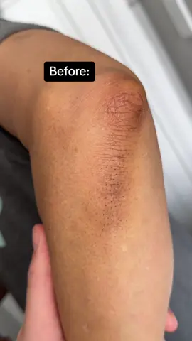 Best treatment for ingrown hairs, stubbly skin & skin texture 💙 #foryoupage #foryou #trending #acne #acneskin #skin #skincare #clearskin #desi  