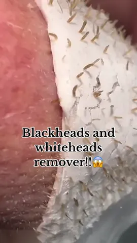 SATISFYING BLACKHEADS AND WHITEHEADS REMOVAL!!😱 #blackheadsremoval #blackheadsremovalproducts #lanbena #lanbenanoseplantsporestrips #lanbenanoseporestrips #nosestrip #lanbenablackheadremover 