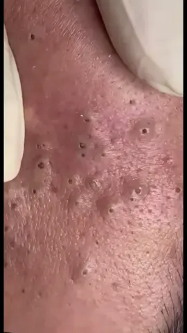 #pimplepoppersatisfying 