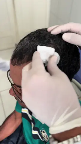 Extração de miíase   QP: Paciente vem ao serviço relatando cefaleia de caráter pulsátil, há 01 semana. Ainda refere prurido e pequena lesão em crânio.   Ao exame: Presença de miíase  CD: Extração da larva  #foryou#viral#medicina#atencaobasicadesaude#medicinadafamiliaecomunidade#miiase#larva#berne 