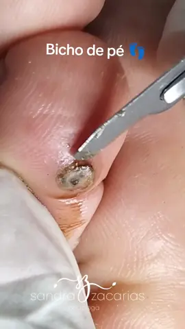 Podologia Bicho de pé 👣