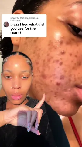 Replying to @Rhonda Balbosa my secret ingredient is Niacinamide 👀 Niacinamide has been a key ingredient in my skincare routine for years to recover from acne scars or even dark spots after acne pimples and it gets a lot easier with the Retinal + Niacinamide Youth Sérum by @Youth To The People 😍 Link in my bio! Did you test it?? #AD #nighttimeroutine #darkspots #glowingskin #clearskin #acne #dryskin #skincareroutine #acnecare #fallskincare
