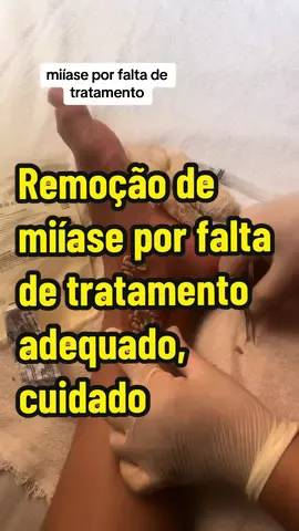 remoção de miíase por falta de tratamento #alerta #infeccao #satisfatorio #cuidado #perigo #miiase #feridas #capcut 