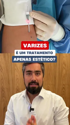 🚩 TRATAMENTO DE VARIZES: É APENAS ESTÉTICO? ☝🏻 Quem diz isso está muito equivocado. A estética é apenas o que nossos olhos conseguem realmente enxergar. O tratamento de varizes é algo muito mais sério e complexo do que podem imaginar! Veias safenas doentes geram insuficiência venosa crônica, e isso pode causar algumas complicações como varicorragia, úlceras varicosas e trombose venosa. 😱  ✨ Precisa tratar suas varizes? Aqui no consultório, fazemos todo o tratamento sem necessidade de raquianestesia nem internação hospitalar! ✨ 👇🏻 Comente 