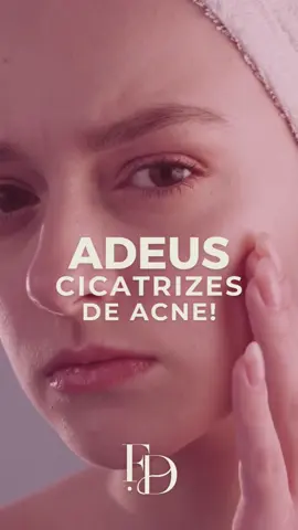 Transforme sua pele em uma tela perfeita: diga adeus às cicatrizes de acne com nosso protocolo avançado. 🙌   Hidratação, firmeza e rejuvenescimento com estímulo de colágeno.   ✨ Resultados incríveis em várias sessões.  Sua pele merece esse cuidado!   Agende já para desvendar sua melhor pele. 👌  #FaceDoctorIpatinga #Ipatinga #PelePerfeita #AdeusAcne #ProtocoloAvançado #FaceDoctorbrasil #clinicaestetica