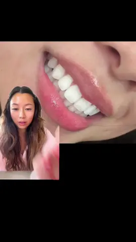 No bc I didn't think I could have whiter teeth?? s/o to my favorite Teeth Whitening Device from @Moon , now available at 35% off this Amazon Prime Day #moon_partner