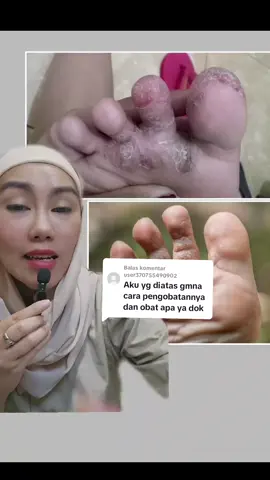 Membalas @user370755490902 #tineapedis #gatalkaki #kakibau #kakipecahpecahhilang #jamurkaki #penyakitkulit #doktertiktokindonesia #edukasikesehatan 