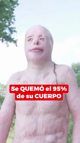 Se QUEMÓ el 95% de su CUERPO #shorts #top #viral #curiosidades