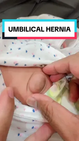 Umbilical Hernia Pusat Angin Pasang 