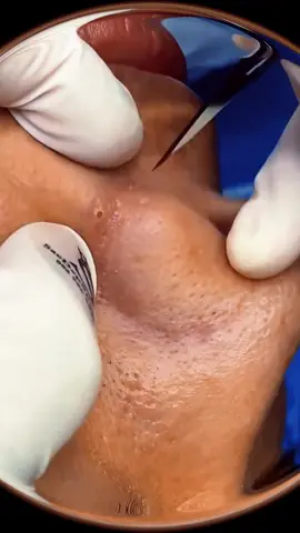 #spa #relax #asmr #acne #pimple #squeeze #earwax #ear #horse #horsecare #dermdoctor #seattle #Toronto #tiktok #viral #foryou