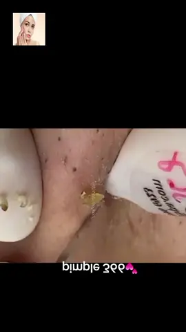 #squeeze #squeezeyuk #acne #pimple #pimplepop #blackhead #satisfying #foryoupage 119