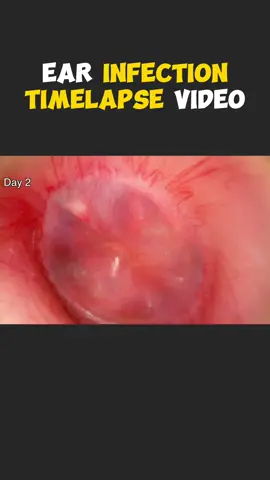Ear Infection Timelapse Video 3D Animation  #earinfection #earinfections #earinfectioncheck #earinfectiontiktok #earpain #eardruminfection #earpaincheck #earpain? #ent #medical3danimation #3dmedicalanimation #medicalprocedure 