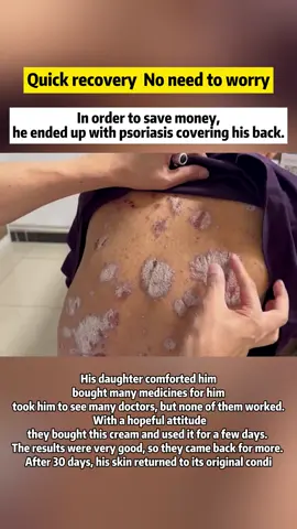 #psoriasis #guttatepsoriasis #symmetricalpsoriasis #psoriasistok #psoriasisawareness #psoriasistreatment #psoriasishelp #fyp #viral #skincare #goodthing #psoriasisjourney #psoriasiswarrior #scalppsoriasis #psoriasisremoval #psoriasischeck #psoriasis #eczema #eczemaawareness #eczematok #eczemaflareup 