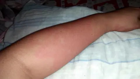 my allergic reaction after eating bullet tuna fish 😢 #saturdaynight #dinner #food #allergy