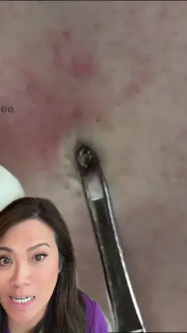 #duet with @Sandra Lee, MD #drpimplepopper a satisfying classic. Not toxic but toxiq #drpimplepopper 