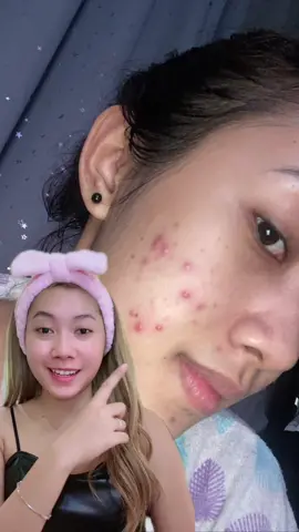 Membalas @Yuli Kurniasih dari jerawatan parah sekarang udah sembuh😍