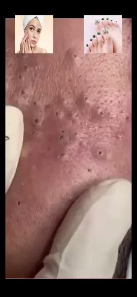 #squeeze #squeezeyuk #acne #pimple #pimplepop #blackhead #satisfying #foryoupage 221