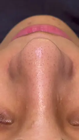 عميق البشره بجهاز الهيدروفيشيال❤️ خلي نورك يخطف الانظار😍 جلسه تنظيف طبي عميق للوجه👌 افضلً جلسات تنضيف عميق للبشره باحدث الاجهزه الهيدروفيشيال والهاي فركوانسي والاسكرابر والديرما بلاننج وبافضل انواع الماسكات 🤩 جلسات تنضيف البشره بتعمل ايه و فايدتها ايه🤔 بتنور ايوه بتنوري حرفيا😘بنشيل الجلد الميت بنشفط الدهون الزائد بنشيل الرؤوس السواد بندخل الماسكات بعمق بنعمل تقشير البشره😍مساج للوجه لتنشيط عضلات الوجه للتخلص من السموم و بنقفل مسام ونفرد التجاعيد وتشغل الدوره الدمويه😍 و عروووووووض جااااااامده جدااااا فى مننا عرايس وبنات داخلة على مناسبات كتير وعشان تكونى جميلة دايما لازم تفكرى ف بشرتك ونضارتها اهتمامك ببشرتك هيفرق#تنظف #بشره_نضره #اهتمام_عرايس #اهتمام_بالبشره #بشره_صافيه #بشره_صافيه_نظره_نقيه_خاليه_من_العيوب #بشره_دهنيه #بشره_صحيه#بشره_صحيه #بشره_نظيفه #تنظيف 