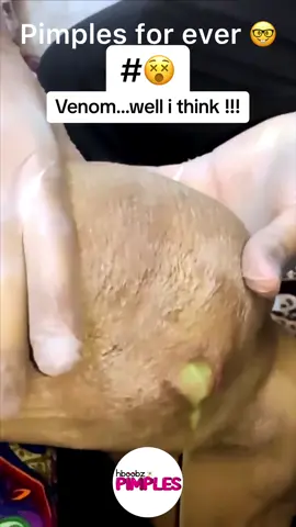 #pimple #pimples #horror #medical #blackhead #bigpimple #whiteheads #pimpleremoval #disgusting #pimplepop #cystexplosion #squeeze #squeezeyuk #skincare #cyst #cystpopping #acnetreatment #acne #abscess #verysatisfying #satisfying 