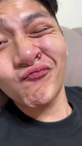 #squeeze #acne #pimple #pimpleremover #squeezeyuk #satisfying #satisfyingvideo 