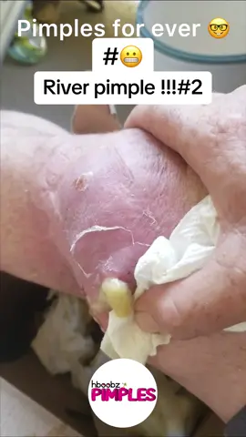 #pimple #pimples #horror #medical #blackhead #bigpimple #whiteheads #pimpleremoval #disgusting #pimplepop #cystexplosion #squeeze #squeezeyuk #skincare #cyst #cystpopping #acnetreatment #acne #abscess #verysatisfying #satisfying 