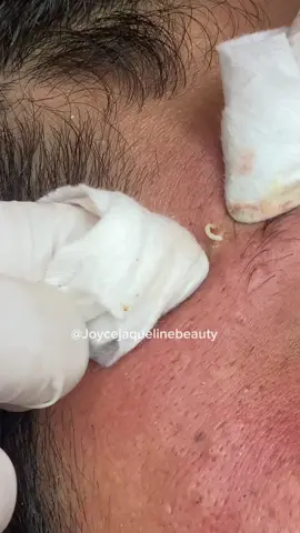 #videosatisfatorio #satisfyingvideo #fy #limpezadepele #poppingpimples #pimple #esteticafacial #tirandocravo 