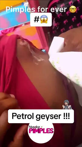 #pimple #pimples #horror #medical #blackhead #bigpimple #whiteheads #pimpleremoval #disgusting #pimplepop #cystexplosion #squeeze #squeezeyuk #skincare #cyst #cystpopping #acnetreatment #acne #abscess #verysatisfying #satisfying 