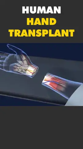 Human Hand Transplant Surgery 3D Animation #handtransplant #handtransplantsurgery #handtransplantworkout #medical3danimation #3dmedicalanimation #handsurgery #handsurgerytoday #armsurgery #armtransplant #brokenhand #brokenhands #brokenhandshurt #nohands #nohand 