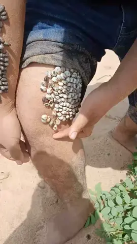 Oh my god so itchy #ticks #ticksremoval #tungrcom #tungrcyess #fyp #fypシ #foryou 